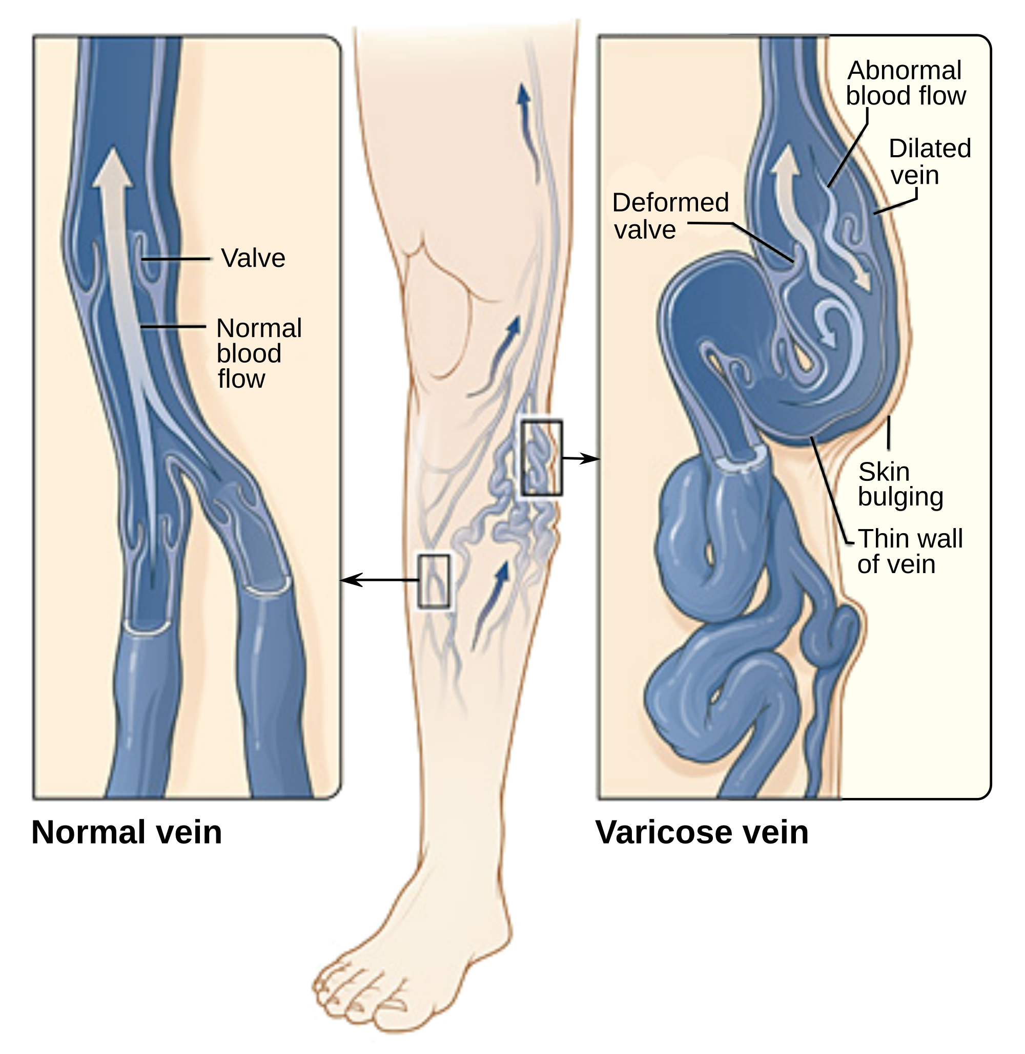 Varicose_veins