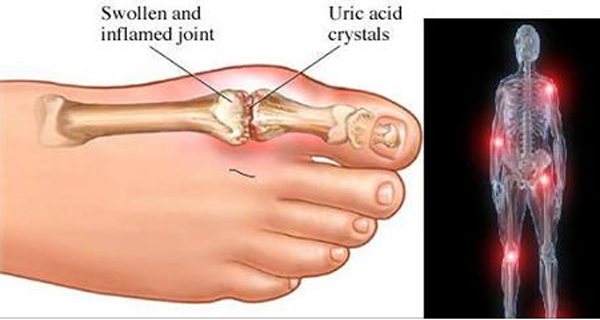 how-to-control-uric-acid-levels-in-10-ways